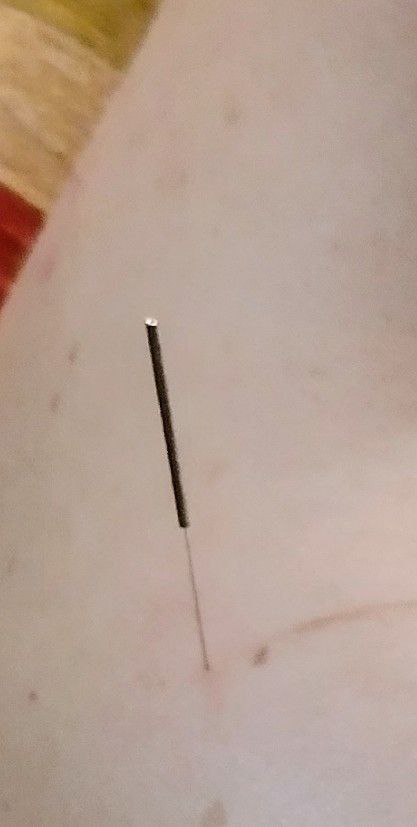 Acupuntura